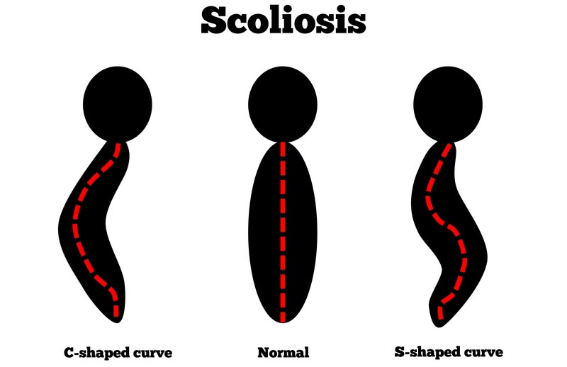 Augusta, ME scoliosis treatment